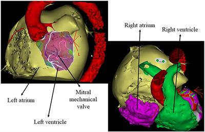 A case report of long-term successful stereotactic arrhythmia radioablation in a cardiac contractility modulation device carrier with giant left atrium, including a detailed dosimetric analysis